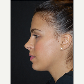 18-24 year old woman treated with Non Surgical Nose Job before 2728548