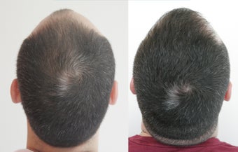3130 Grafts FUE 11 Months Post Op after 1428256
