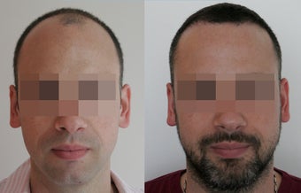 3130 Grafts FUE 11 Months Post Op before 1428256