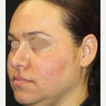 25-34 year old woman treated with Skin Lightening after 3089494