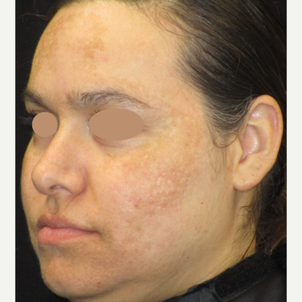 25-34 year old woman treated with Skin Lightening before 3089494