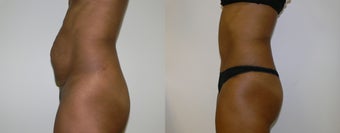 Tummy tuck to repair muscle diastasis after pregnancy before 1399697