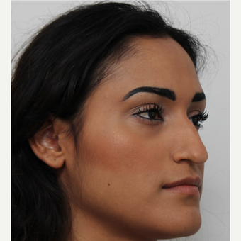 25-34 year old woman treated with Rhinoplasty before 3372293