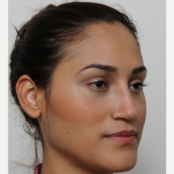 25-34 year old woman treated with Rhinoplasty after 3372293