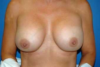 capsular contracture after 1057449