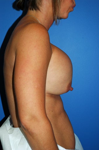capsular contracture 1057449