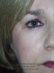 Mohs Surgery of Lentigo Maligna (Melanoma) and Reconstruction after 315082