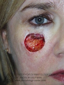 Mohs Surgery of Lentigo Maligna (Melanoma) and Reconstruction 315082