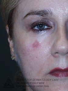 Mohs Surgery of Lentigo Maligna (Melanoma) and Reconstruction before 315082