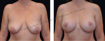 Breast Lift with Implants before 1392153