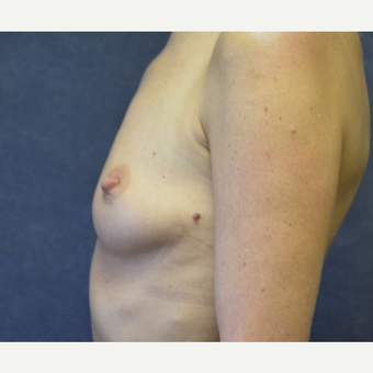 45-54 year old woman treated with Breast Implants before 3455416