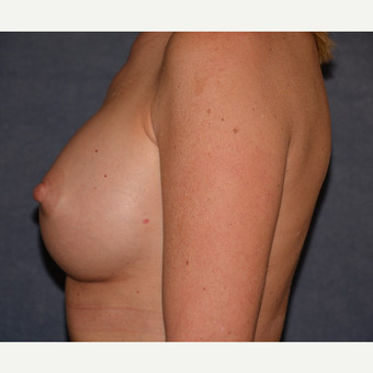 45-54 year old woman treated with Breast Implants after 3455416