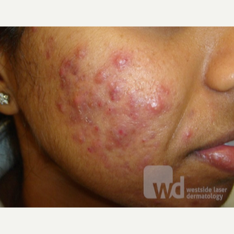 Acne treatments in ethnic skin types- reduces acne scarring before 3696987