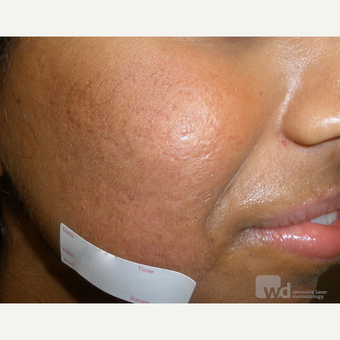 Acne treatments in ethnic skin types- reduces acne scarring after 3696987