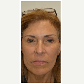 55-64 year old woman treated with Thread Lift after 3147880