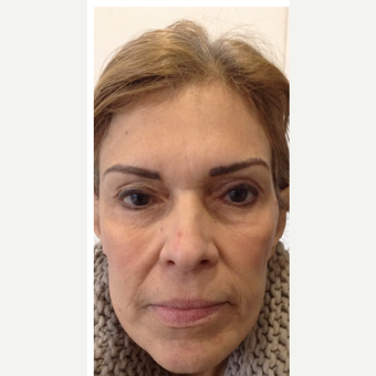 55-64 year old woman treated with Thread Lift before 3147880