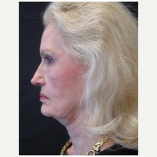 65-74 year old woman treated with Facelift before 3088557