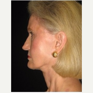 65-74 year old woman treated with Facelift after 3088557