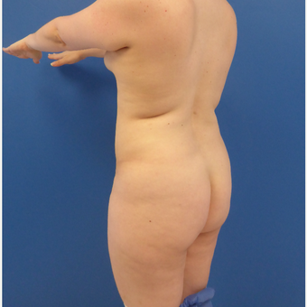 27 y/o female - 1500cc per side Lipo abdomen, flanks, back with fat transfer to the buttocks before 3433793