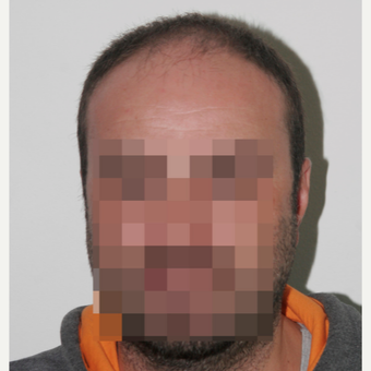 33 years old man treated with FUE Hair Transplant before 3068907