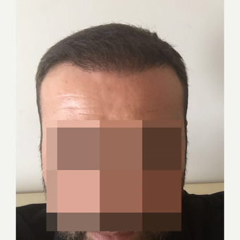 33 years old man treated with FUE Hair Transplant after 3068907