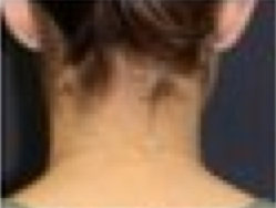 Otoplasty 210178
