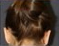 Otoplasty 210178