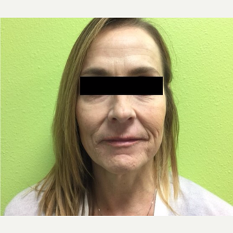 45-54 year old woman treated with Infini RF before 3816770