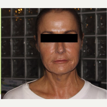 45-54 year old woman treated with Infini RF after 3816770