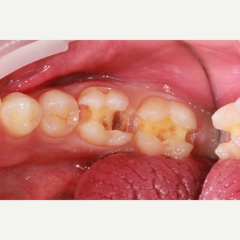White composite fillings - Back teeth before 3096753