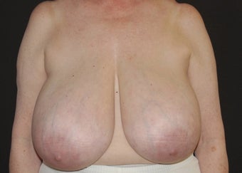 Breast Reduction before 949238