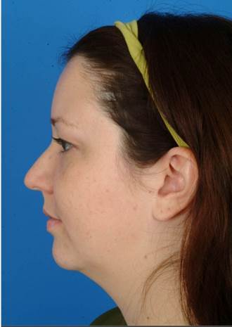 29 year old treated with Ultherapy for more definition in the neck and jawline and lift of the brows. before 1173979