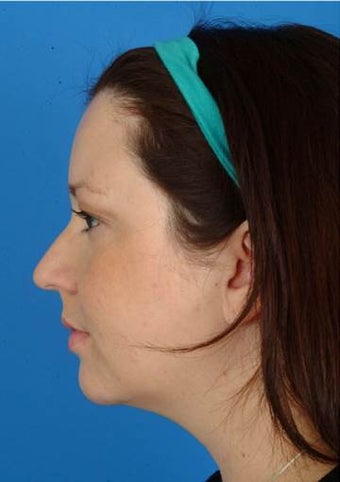 29 year old treated with Ultherapy for more definition in the neck and jawline and lift of the brows. after 1173979