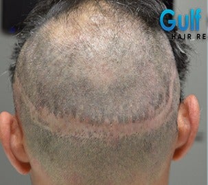 35-44 year old man treated with FUE Hair Transplant before 3604730