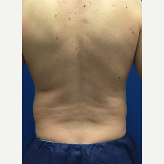 35-44 year old man treated with Liposuction of the love handles before 3071911