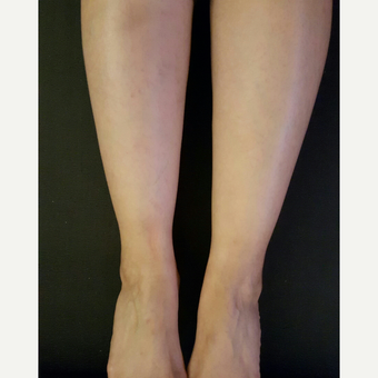 25-34 year old woman treated with Liposuction Revision after 2681269