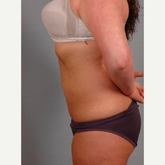 25-34 year old woman treated with Smart Lipo 1597702