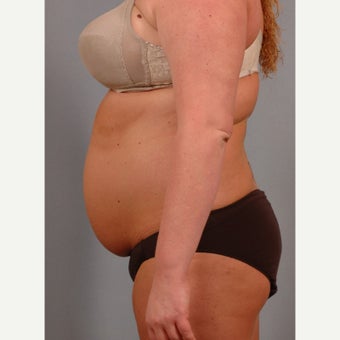25-34 year old woman treated with Smart Lipo 1597702