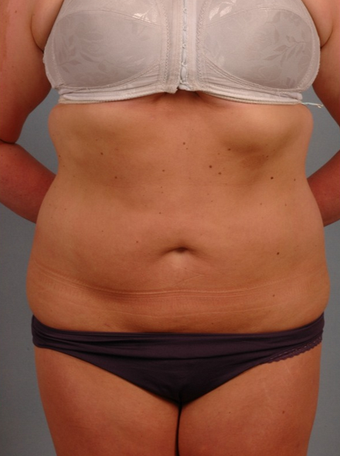 25-34 year old woman treated with Smart Lipo after 1597702