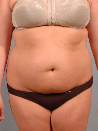 25-34 year old woman treated with Smart Lipo before 1597702