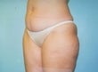 39 year old female patient 926805