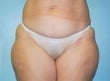 39 year old female patient before 926805
