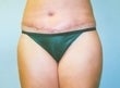 39 year old female patient after 926805