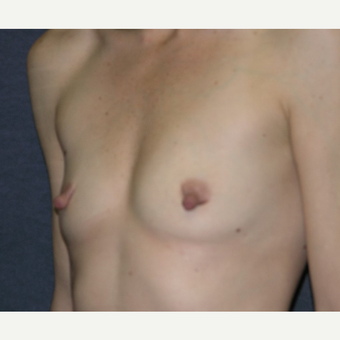 35-44 year old woman treated with Breast Implants before 3455374