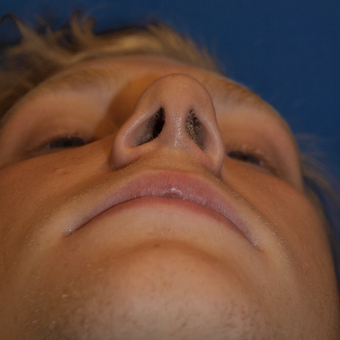 18-24 year old man treated with Rhinoplasty after 3326278