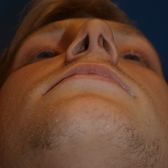 18-24 year old man treated with Rhinoplasty before 3326278