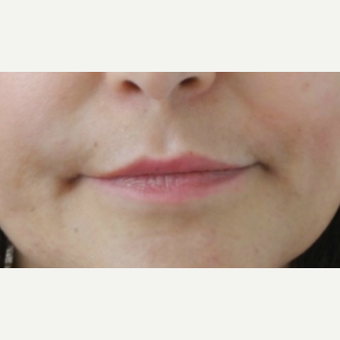 55-64 year old woman treated with Lip Augmentation before 3300541