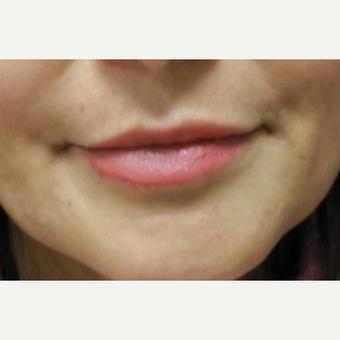 55-64 year old woman treated with Lip Augmentation after 3300541