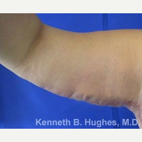 Arm Lift after 3094509