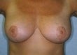 34 year old female patient after 933221